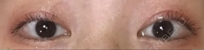 二重埋没 湘南美容クリニック 京都院 AFTER メイン用