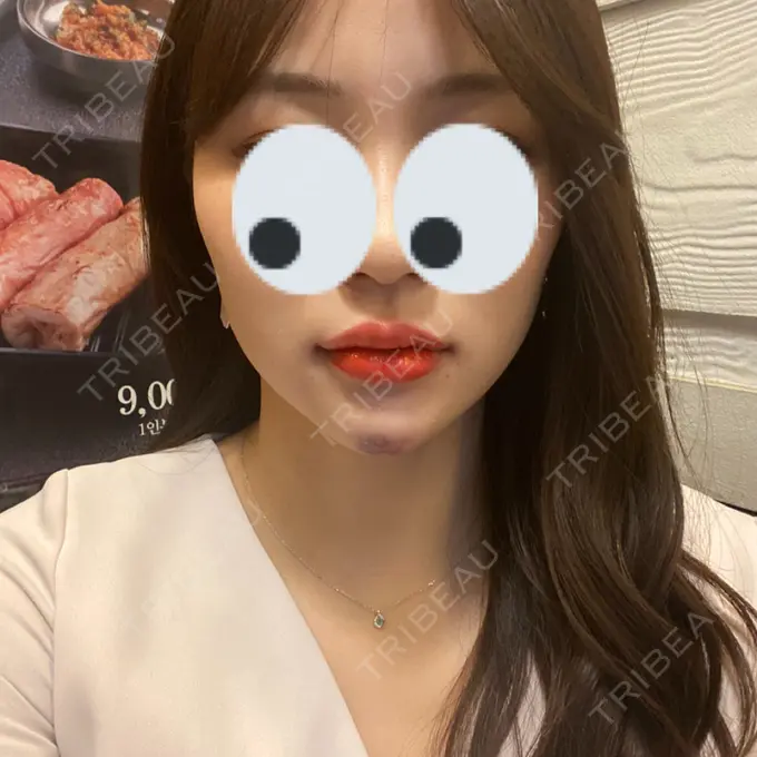 ボトックス（あご） / ヒアルロン酸注入（あご） / ボトックス（エラ・小顔） / 脂肪溶解注射（顔） クリニックA.O. AFTER メイン用