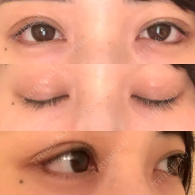 眼瞼下垂（切開） / 目尻切開 / タレ目形成・グラマラスライン（切開） プロミス整形外科 DAY 13 メイン用