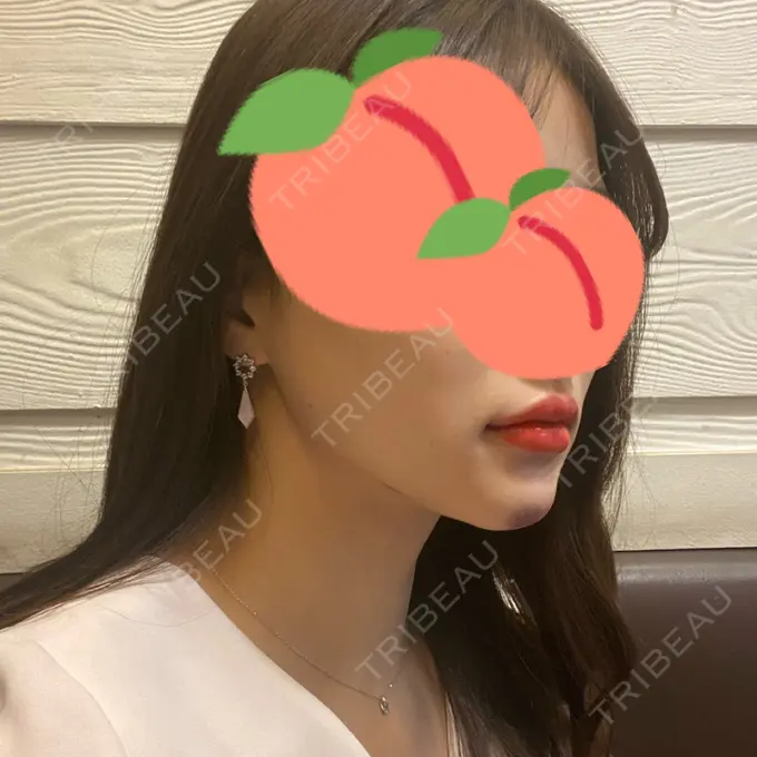 ボトックス（あご） / ヒアルロン酸注入（あご） / ボトックス（エラ・小顔） / 脂肪溶解注射（顔） クリニックA.O. DAY 3 メイン用