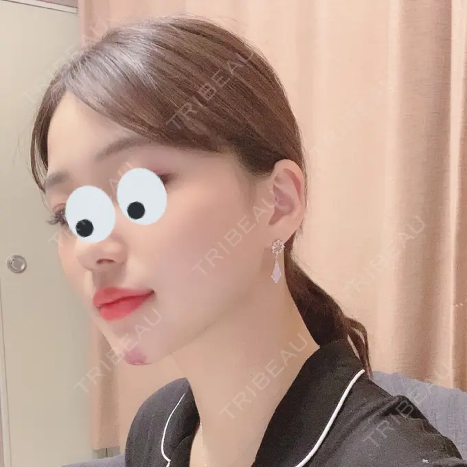 ボトックス（あご） / ヒアルロン酸注入（あご） / ボトックス（エラ・小顔） / 脂肪溶解注射（顔） クリニックA.O. DAY 3 メイン用