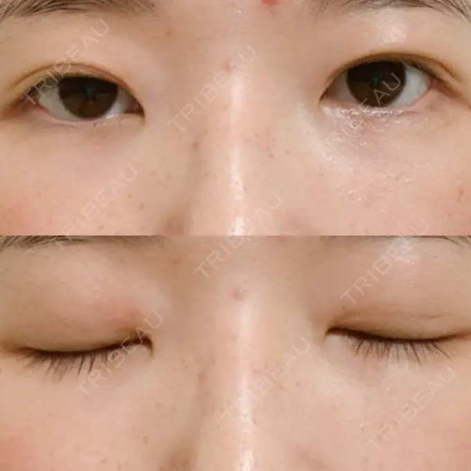 二重埋没 湘南美容クリニック 東京蒲田院 DAY 37 メイン用