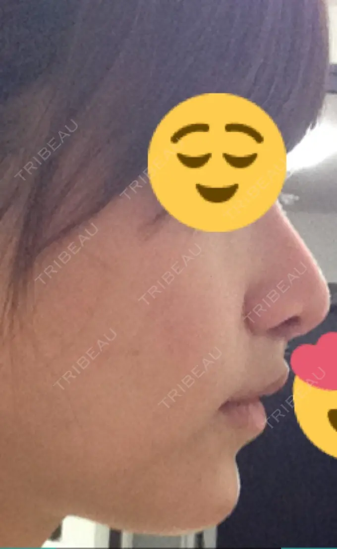 小鼻縮小（切開） / 人中短縮 南クリニック DAY 13 メイン用