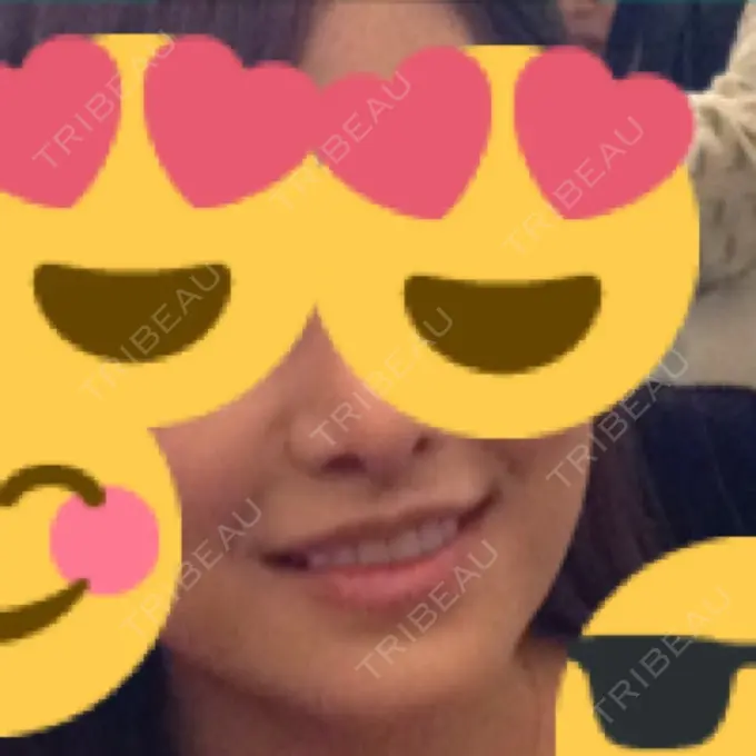 小鼻縮小（切開） / 人中短縮 南クリニック DAY 13 メイン用