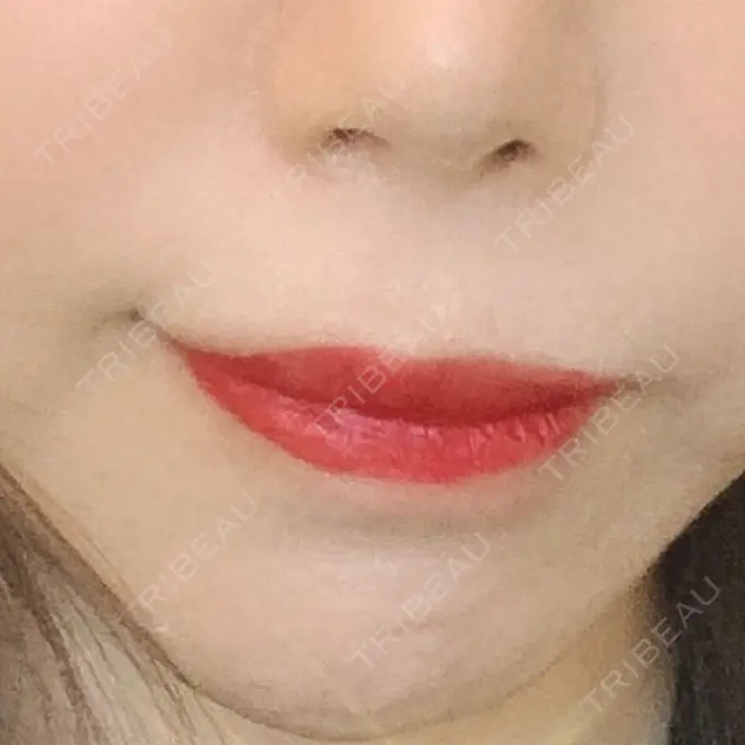 人中短縮 東京皮膚科・形成外科 (銀座いけだクリニック) AFTER メイン用