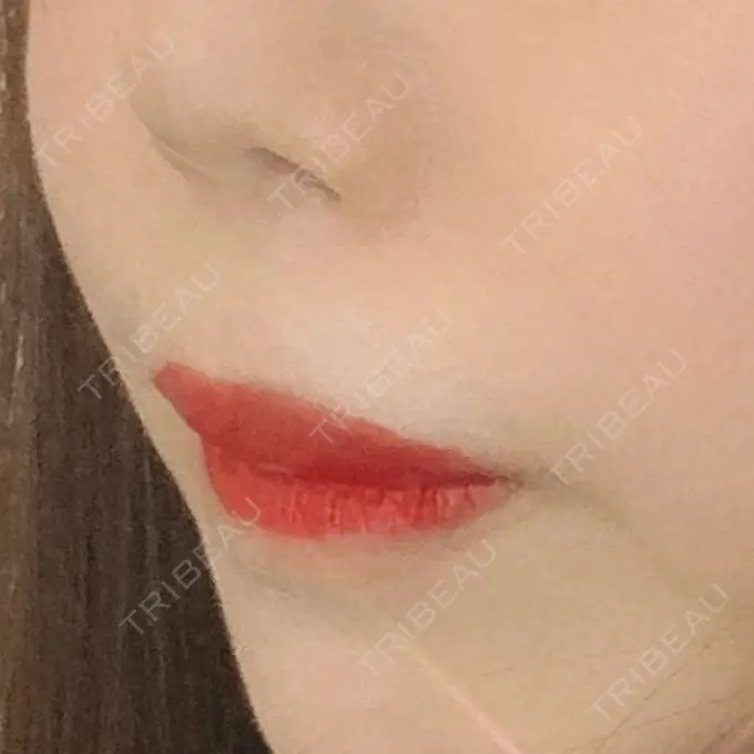 人中短縮 東京皮膚科・形成外科 (銀座いけだクリニック) DAY 457 メイン用