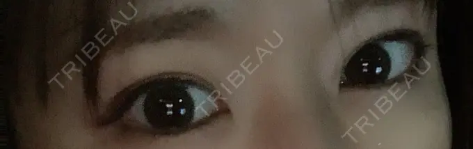 二重埋没 湘南美容クリニック 金沢院 DAY 7 メイン用