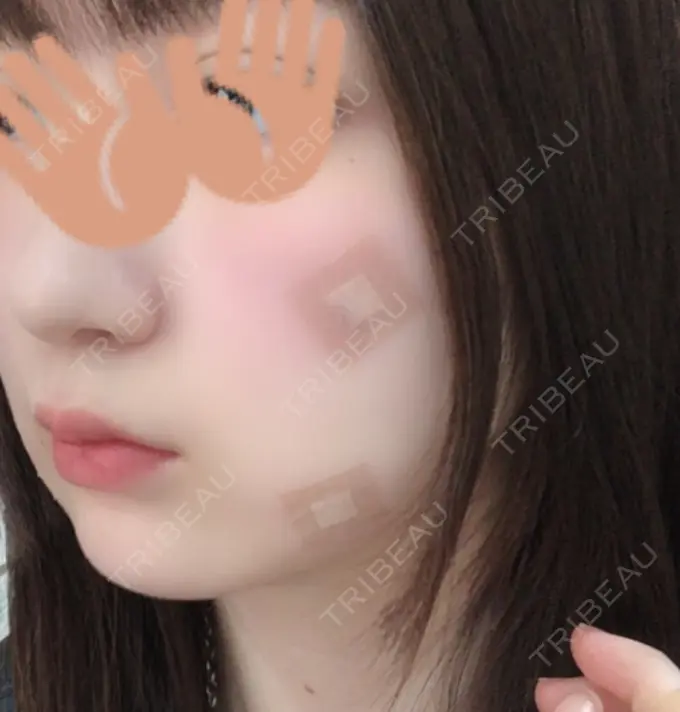 脂肪溶解注射（顔） / ヒアルロン酸注入（頬） 赤坂プレミアクリニック DAY 0 メイン用