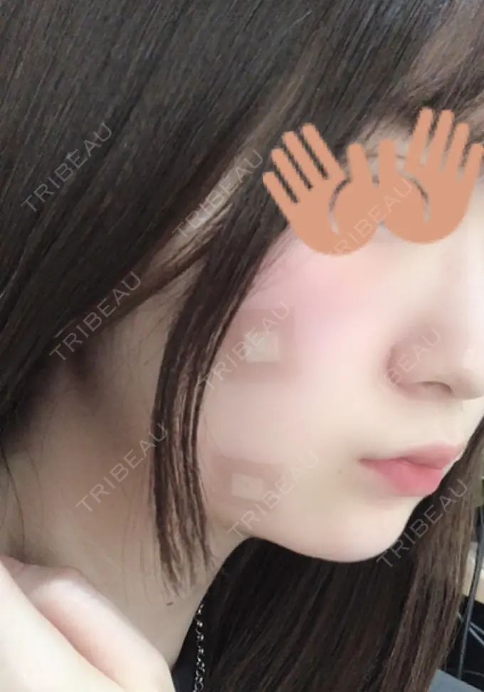 脂肪溶解注射（顔） / ヒアルロン酸注入（頬） 赤坂プレミアクリニック DAY 0 メイン用