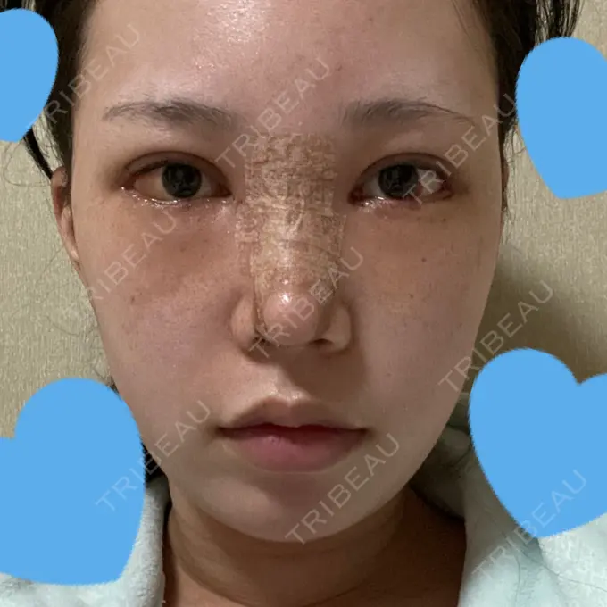 目頭切開 / 鼻尖形成（切開） / 額を丸く / 目尻切開 / 上まぶたの脂肪取り / 軟骨移植 / 脂肪注入（輪郭） TN整形外科 DAY 7 メイン用