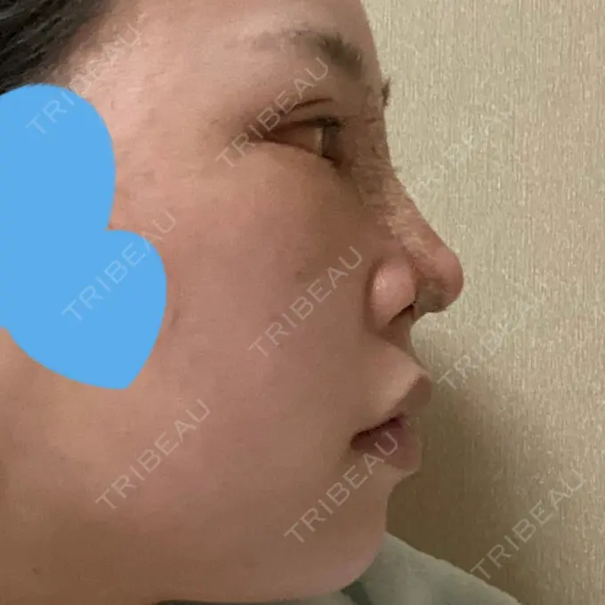 目頭切開 / 鼻尖形成（切開） / 額を丸く / 目尻切開 / 上まぶたの脂肪取り / 軟骨移植 / 脂肪注入（輪郭） TN整形外科 DAY 7 メイン用