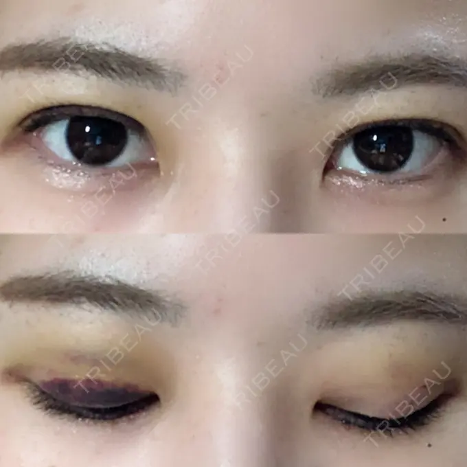 二重埋没 / 上まぶたの脂肪取り 湘南美容クリニック 柏院 DAY 5 メイン用