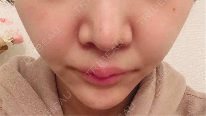 人中短縮 新宿ラクル美容外科クリニック 新宿院 DAY 11 メイン用