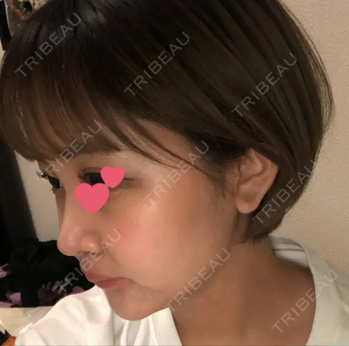 人中短縮 新宿ラクル美容外科クリニック 新宿院 DAY 11 メイン用