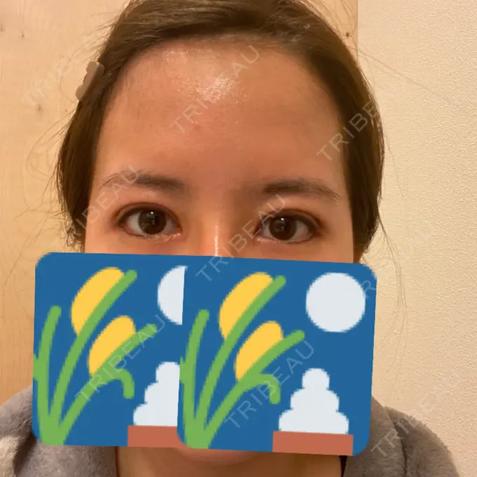 二重切開 / 目頭切開 / 眼瞼下垂（切開） / 目尻切開 RG整形外科（旧リオン整形外科） DAY 25 メイン用