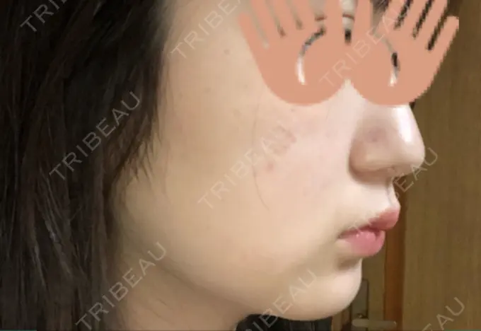 脂肪溶解注射（顔） / ヒアルロン酸注入（頬） 赤坂プレミアクリニック AFTER メイン用