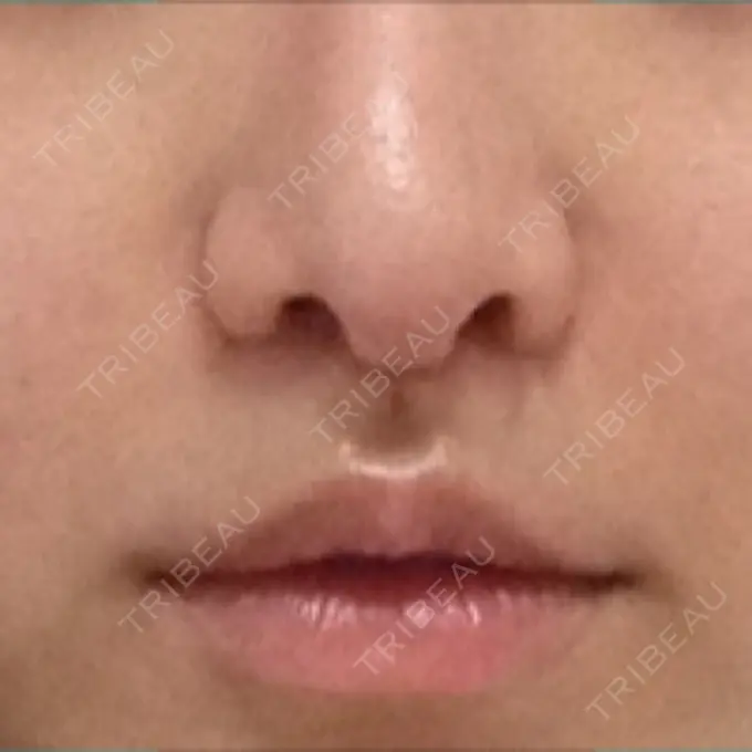 小鼻縮小（切開） / 人中短縮 南クリニック DAY 18 メイン用