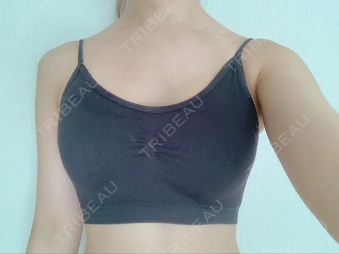 豊胸（シリコンバッグ） ウォンジン（Wonjin）整形外科 DAY 29 メイン用