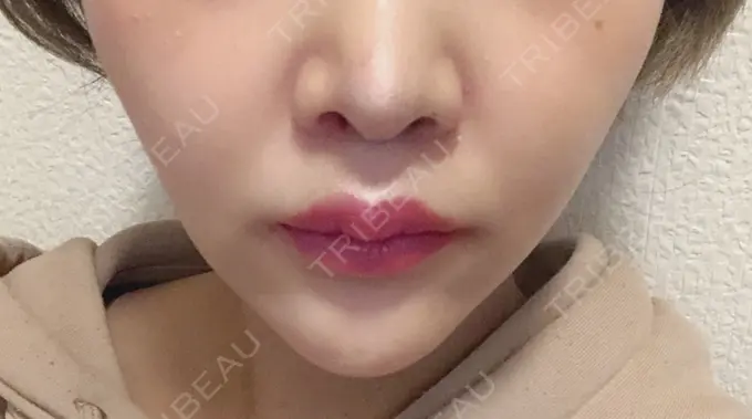 人中短縮 新宿ラクル美容外科クリニック 新宿院 DAY 12 メイン用