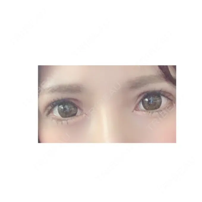 二重切開 / 目頭切開 / 眼瞼下垂（切開） RG整形外科（旧リオン整形外科） DAY 11 メイン用