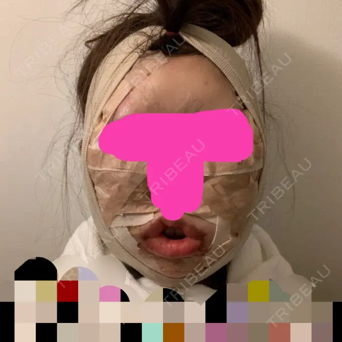 糸リフト / 骨切り（あご） / 骨削り（エラ） / 骨削り（頬） / 脂肪吸引（顔） / 脂肪注入（輪郭） RG整形外科（旧リオン整形外科） DAY 1 メイン用