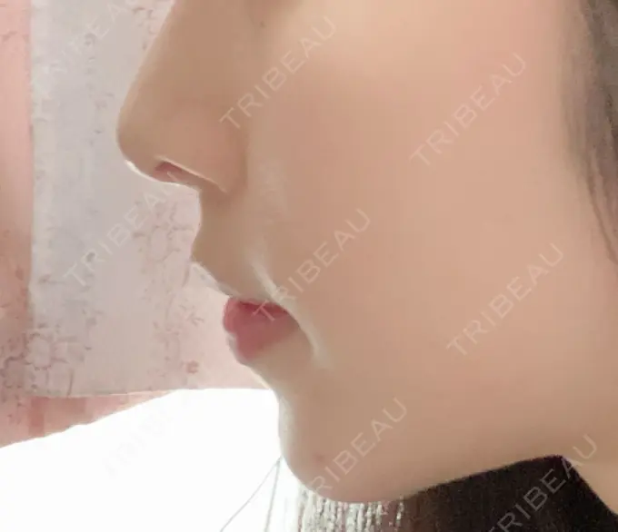 あごプロテーゼ / 骨切り（あご） / 脂肪吸引（顔） 心斎橋コムロ美容外科クリニック DAY 55 メイン用