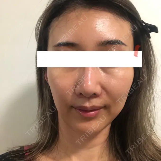 糸リフト / 額を丸く / 人中短縮 / こめかみ形成 / ヒアルロン酸注入（あご） / ボトックス（エラ・小顔） / ヒアルロン酸注入（頬） あきこクリニック DAY 46 メイン用