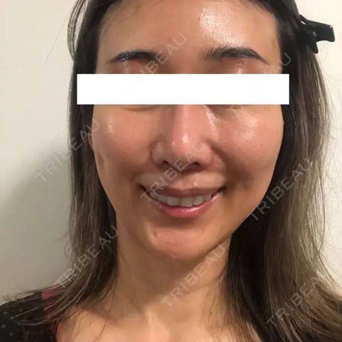 糸リフト / 額を丸く / 人中短縮 / こめかみ形成 / ヒアルロン酸注入（あご） / ボトックス（エラ・小顔） / ヒアルロン酸注入（頬） あきこクリニック DAY 46 メイン用