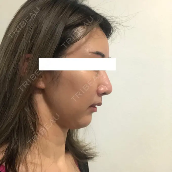 糸リフト / 額を丸く / 人中短縮 / こめかみ形成 / ヒアルロン酸注入（あご） / ボトックス（エラ・小顔） / ヒアルロン酸注入（頬） あきこクリニック DAY 46 メイン用