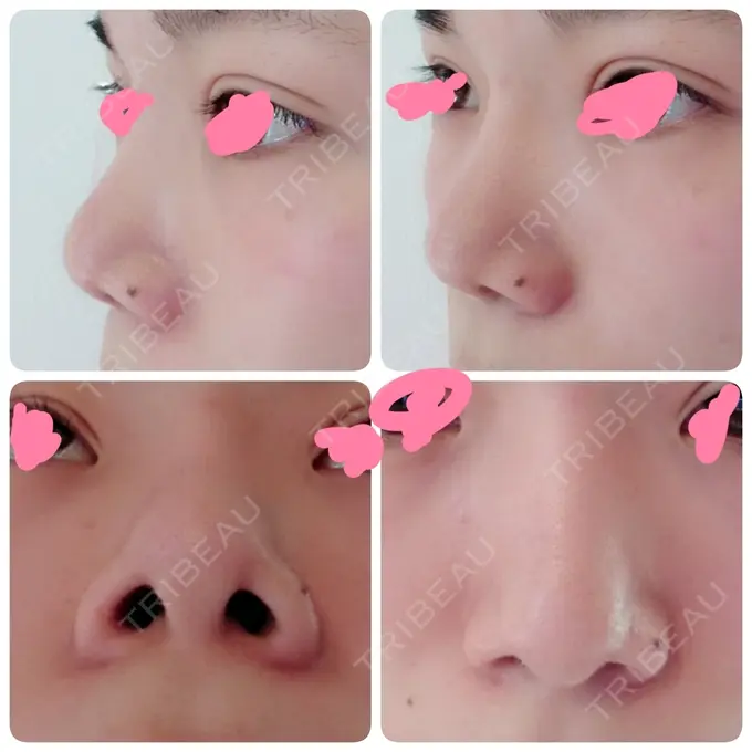 隆鼻術 / 鼻尖形成（切開） / 鼻尖縮小 ヤスミクリニック AFTER メイン用