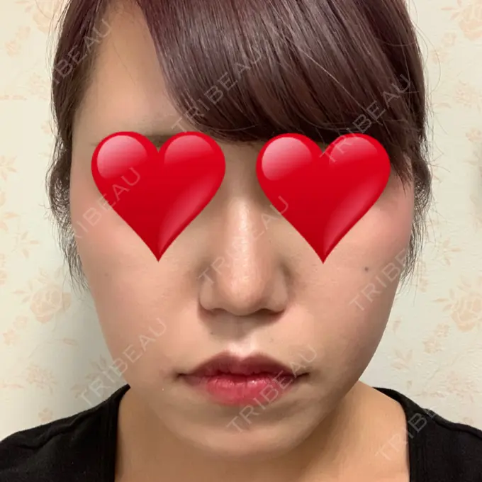 鼻尖形成（切開） / ヒアルロン酸注入（鼻） / その他（鼻） 高崎TAクリニック DAY 34 メイン用