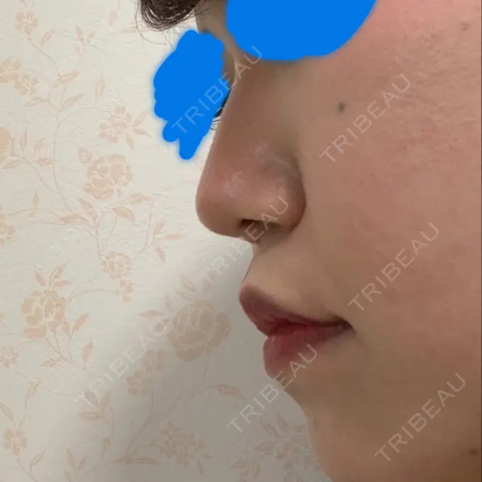 鼻尖形成（切開） / ヒアルロン酸注入（鼻） / その他（鼻） 高崎TAクリニック DAY 34 メイン用