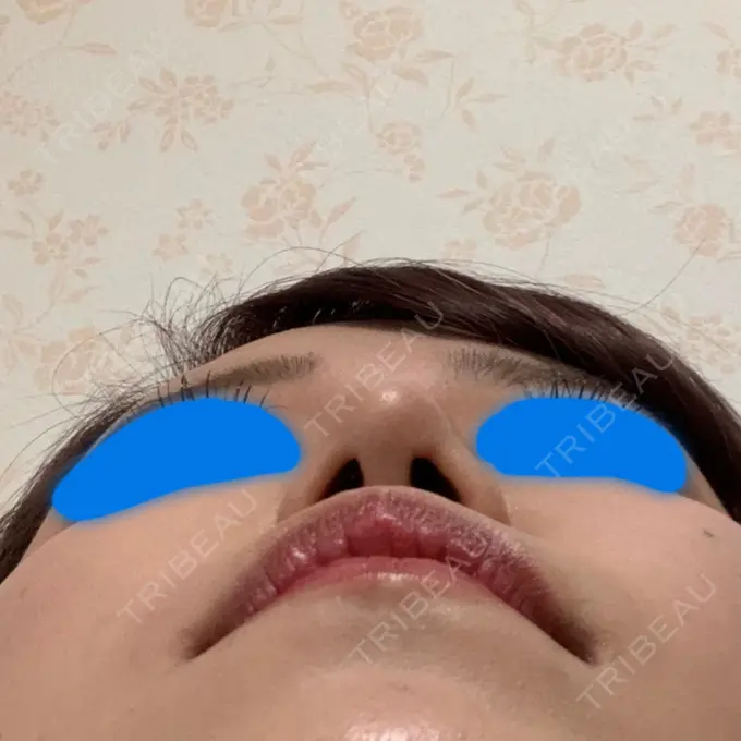 鼻尖形成（切開） / ヒアルロン酸注入（鼻） / その他（鼻） 高崎TAクリニック DAY 34 メイン用