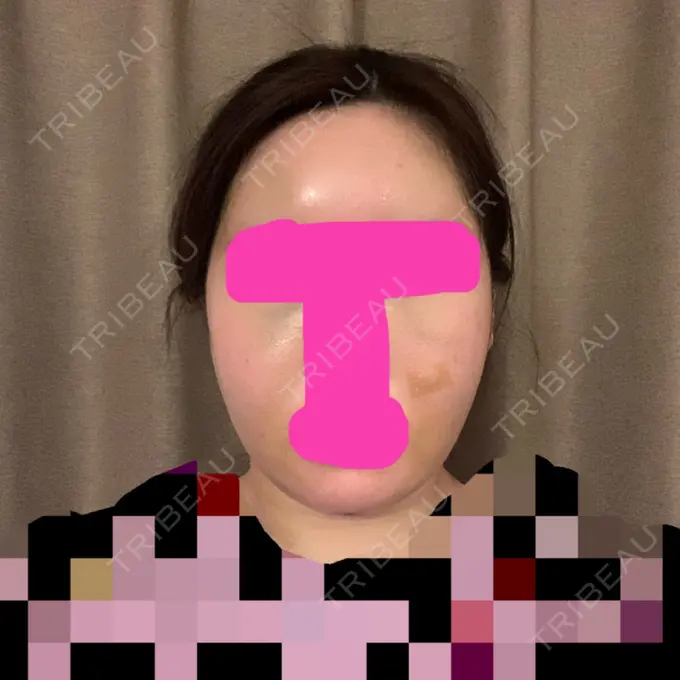 糸リフト / 骨切り（あご） / 骨削り（エラ） / 骨削り（頬） / 脂肪吸引（顔） / 脂肪注入（輪郭） RG整形外科（旧リオン整形外科） DAY 4 メイン用