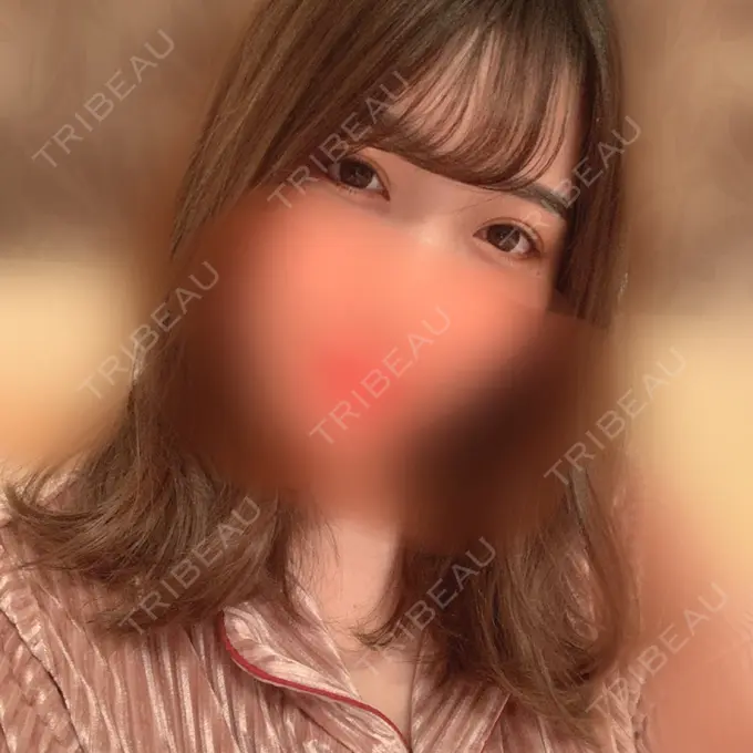 眼瞼下垂（切開） / 目尻切開 / タレ目形成・グラマラスライン（切開） プロミス整形外科 DAY 19 メイン用