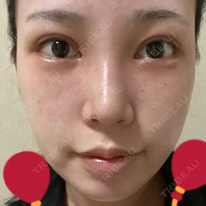 目頭切開 / 鼻尖形成（切開） / 額を丸く / 目尻切開 / 上まぶたの脂肪取り / 軟骨移植 / 脂肪注入（輪郭） TN整形外科 DAY 11 メイン用