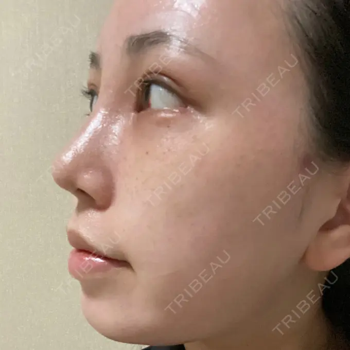 目頭切開 / 鼻尖形成（切開） / 額を丸く / 目尻切開 / 上まぶたの脂肪取り / 軟骨移植 / 脂肪注入（輪郭） TN整形外科 DAY 11 メイン用