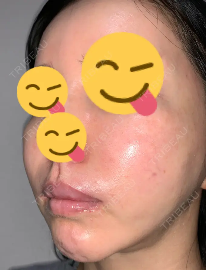 糸リフト / 肌ヒアルロン酸注入（たるみ・シワ改善） / 水光注射（ハリ・美肌） / シワ取りボトックス ウィーバー美容外科 DAY 39 メイン用