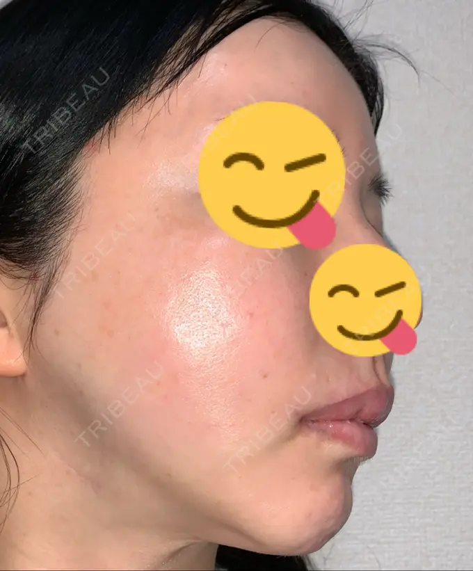 糸リフト / 肌ヒアルロン酸注入（たるみ・シワ改善） / 水光注射（ハリ・美肌） / シワ取りボトックス ウィーバー美容外科 DAY 39 メイン用