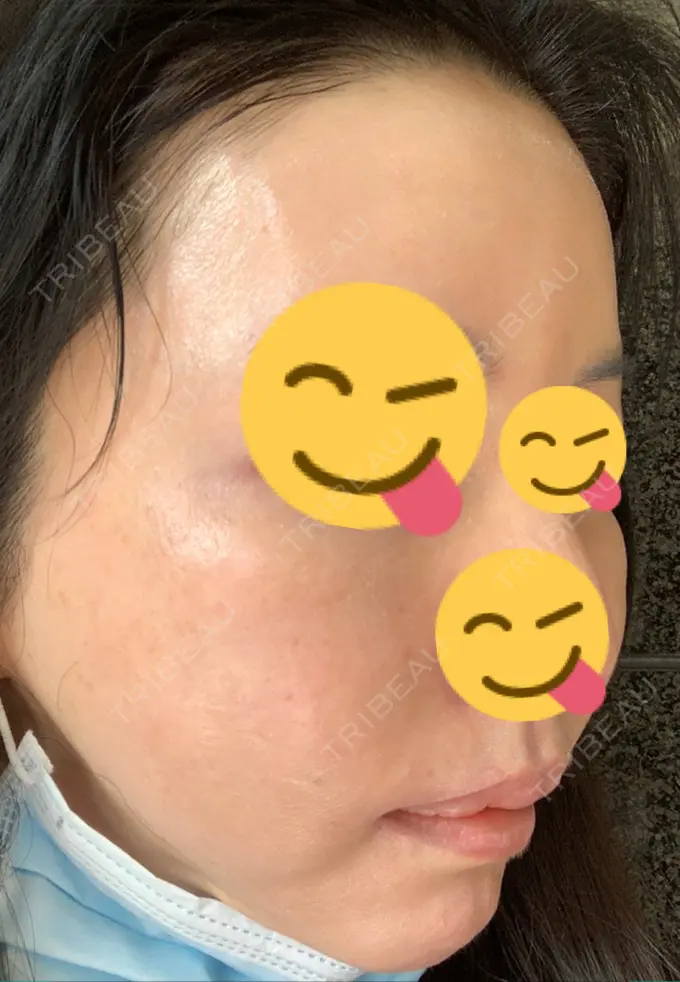 糸リフト / 肌ヒアルロン酸注入（たるみ・シワ改善） / 水光注射（ハリ・美肌） / シワ取りボトックス ウィーバー美容外科 DAY 34 メイン用