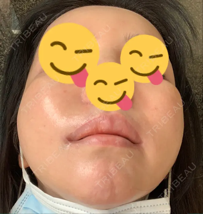 糸リフト / 肌ヒアルロン酸注入（たるみ・シワ改善） / 水光注射（ハリ・美肌） / シワ取りボトックス ウィーバー美容外科 DAY 34 メイン用