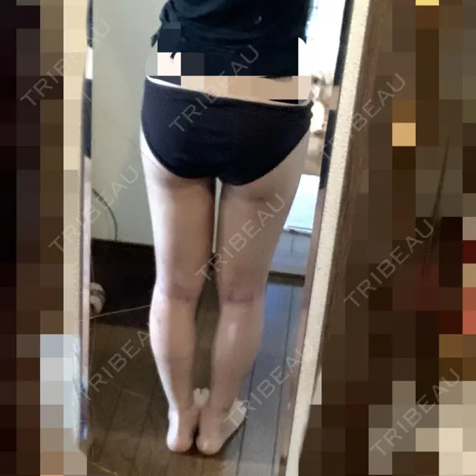 脂肪吸引（脚） / 脂肪吸引（お尻） ザ・セロイ美容外科医院 DAY 14 メイン用