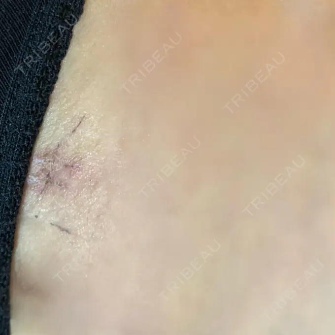 脂肪吸引（脚） / 脂肪吸引（お尻） ザ・セロイ美容外科医院 DAY 14 メイン用