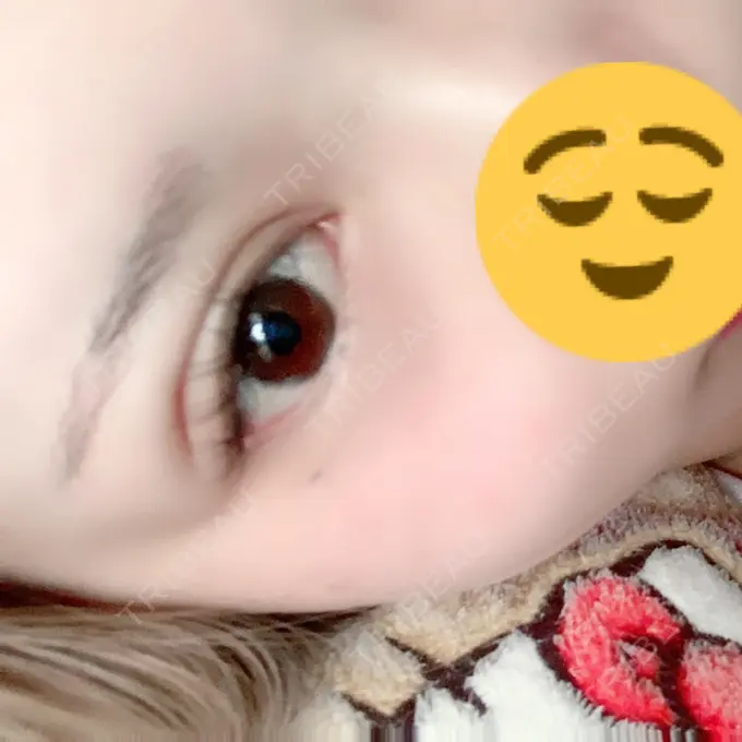 二重埋没 城本クリニック 福岡院 DAY 2 メイン用