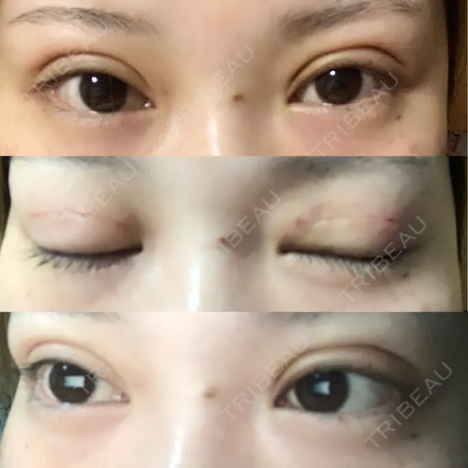 二重埋没 城本クリニック 福岡院 DAY 2 メイン用