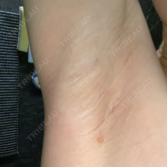 豊胸（シリコンバッグ） / 豊胸（ヒアルロン酸） ヴェリテクリニック 大阪院 AFTER メイン用