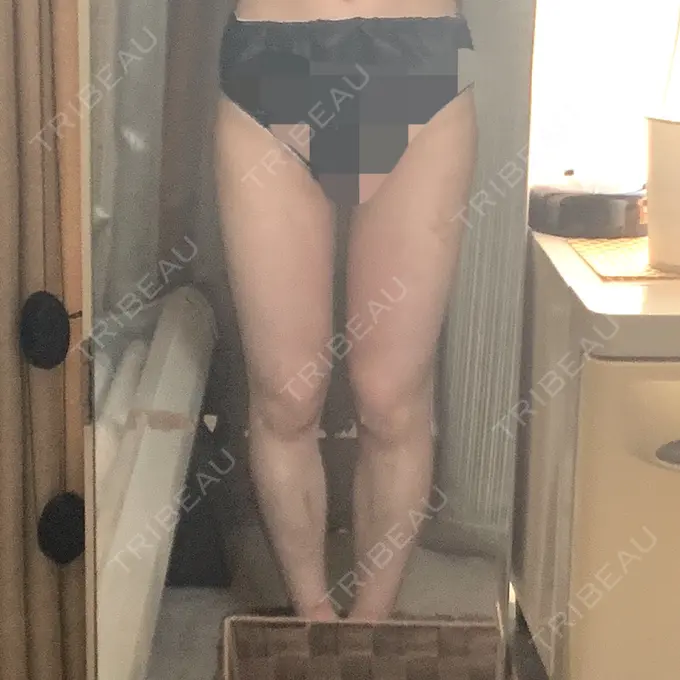 脂肪吸引（脚） / 脂肪吸引（お尻） ザ・セロイ美容外科医院 DAY 20 メイン用