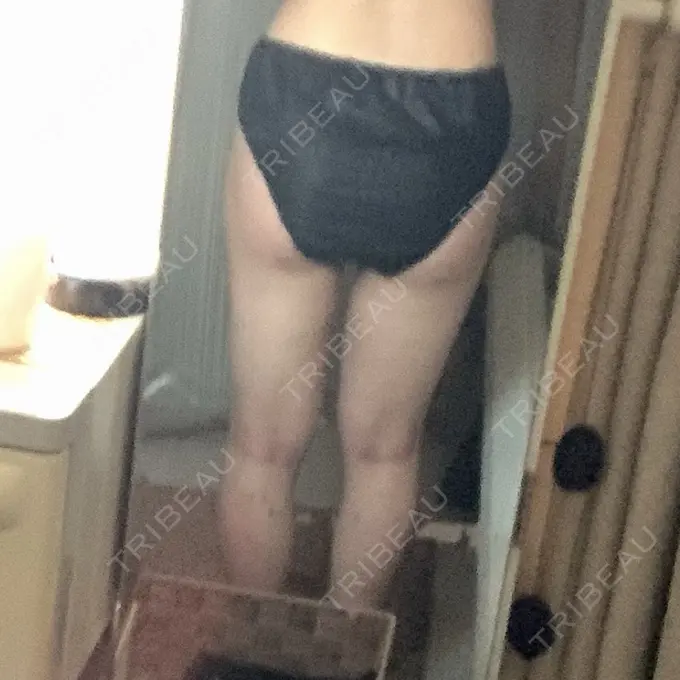 脂肪吸引（脚） / 脂肪吸引（お尻） ザ・セロイ美容外科医院 DAY 20 メイン用