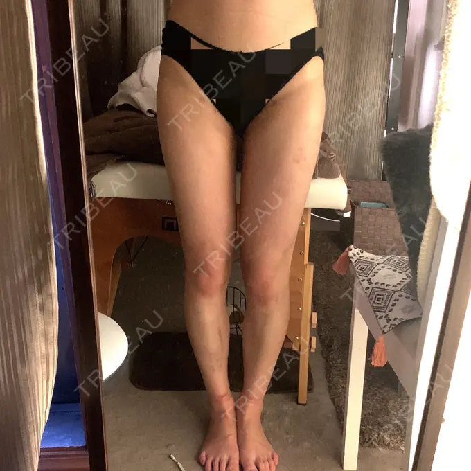 脂肪吸引（脚） / 脂肪吸引（お尻） ザ・セロイ美容外科医院 DAY 20 メイン用