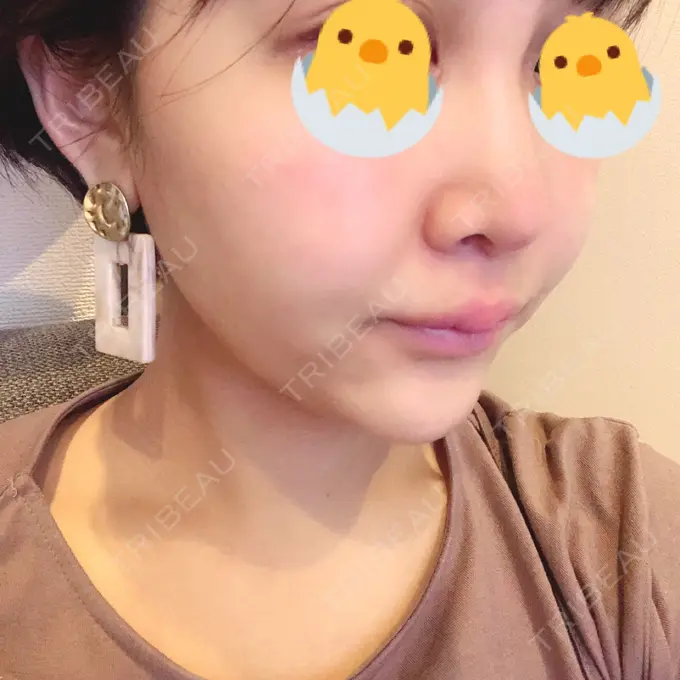 人中短縮 新宿ラクル美容外科クリニック 新宿院 DAY 18 メイン用